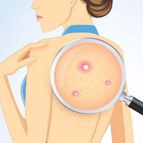 Top 10 Spa trị mụn lưng uy tín & hiệu quả tại TPHCM