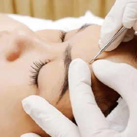 Top 5 địa chỉ nặn mụn uy tín nhất tại TPHCM
