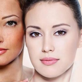Review dịch vụ giảm nám da tại Gò Vấp của Lê Thủy Spa