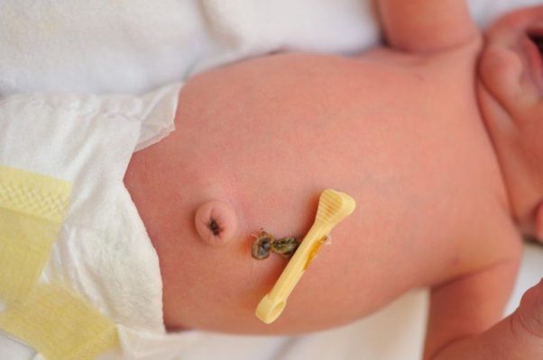 Vệ sinh rốn sau khi rụng cho trẻ đúng cách và một số lưu ý quan trọng