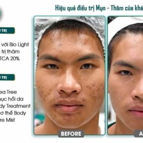 Thẩm mỹ viện Anchee - Trung tâm điều trị thâm mụn hiệu quả tại TP HCM