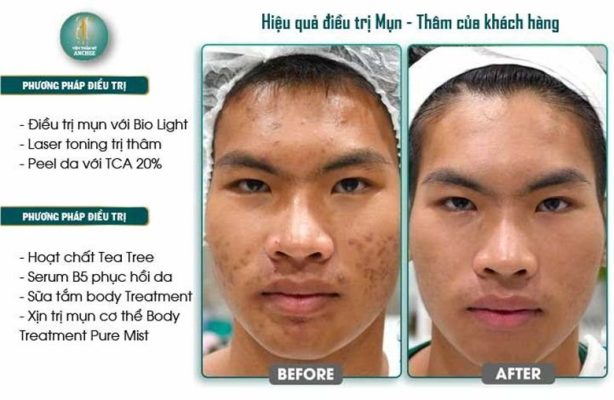 Thẩm mỹ viện Anchee - Trung tâm điều trị thâm mụn hiệu quả tại TP HCM