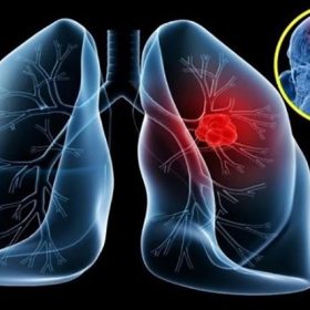 Thuốc đích điều trị ung thư phổi thế hệ thứ 3
