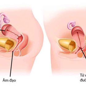 Sản phẩm nào chữa sa tử cung tốt nhất hiện nay?