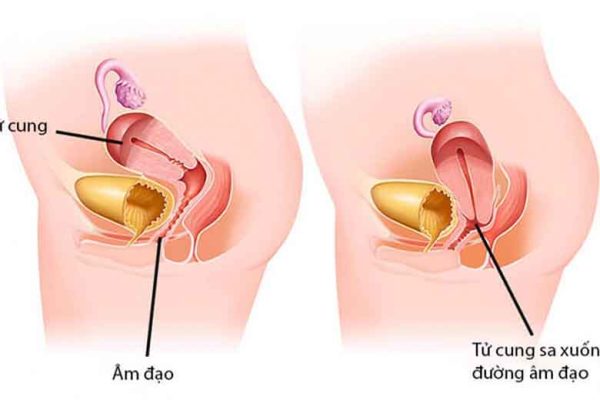 Sản phẩm nào chữa sa tử cung tốt nhất hiện nay?