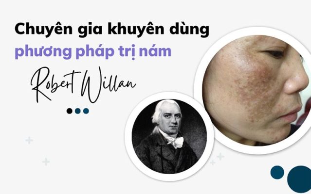 Chuyên gia da liễu khuyên dùng phương pháp trị nám Robert Willan