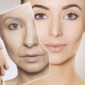 Các phương pháp căng da mặt được lựa chọn hiện nay